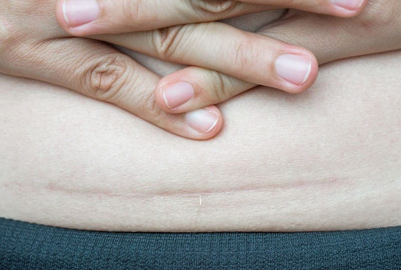 foto ravvicinata della cicatrice scura del ventre di una donna a causa di un parto cesareo