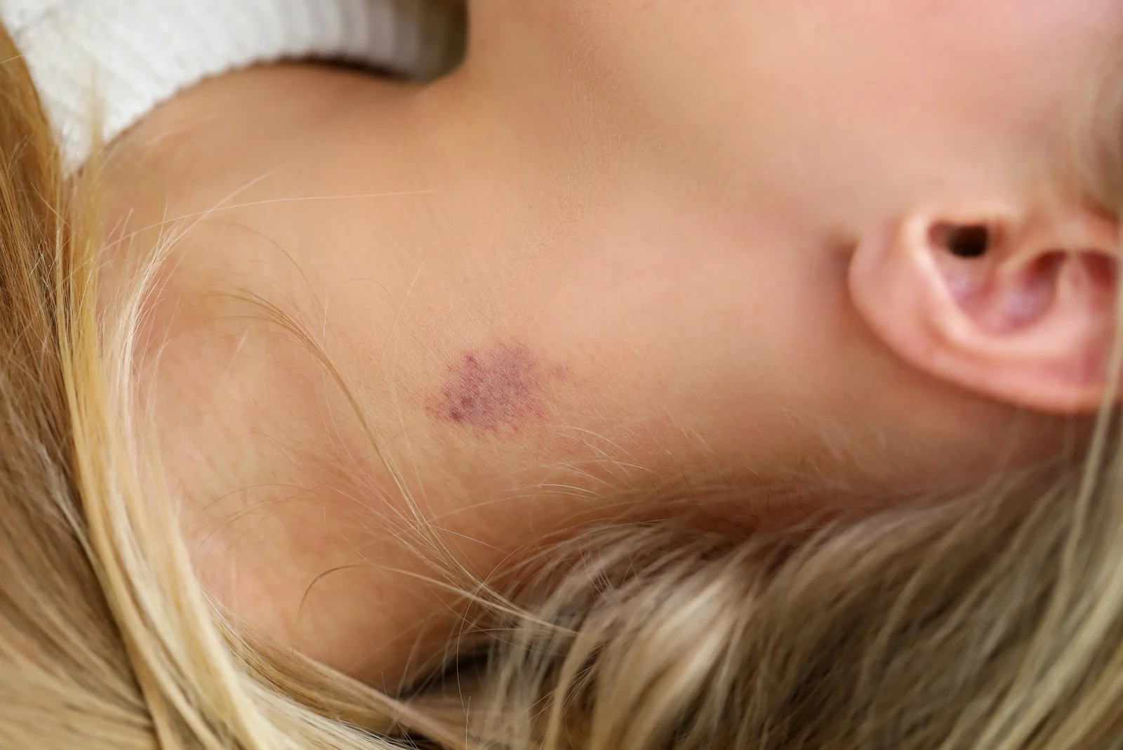 What Can Cause Hickey Like Marks